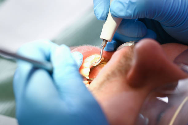 Best Emergency Tooth Extraction in Milford Mill, MD